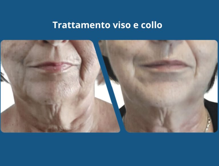 Viso collo HIFU