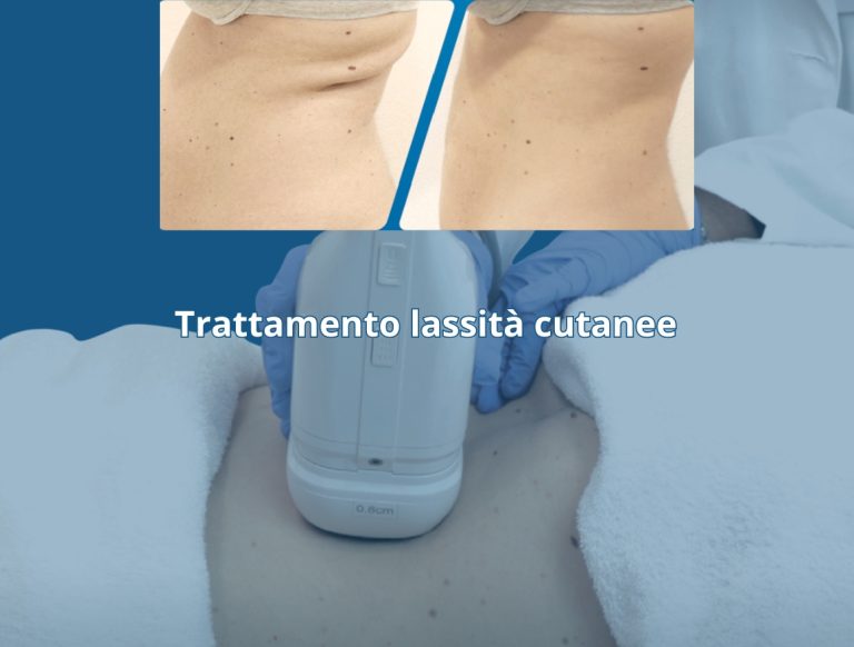 lassita HIFU