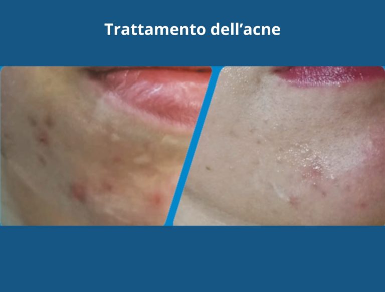 trattamento acne