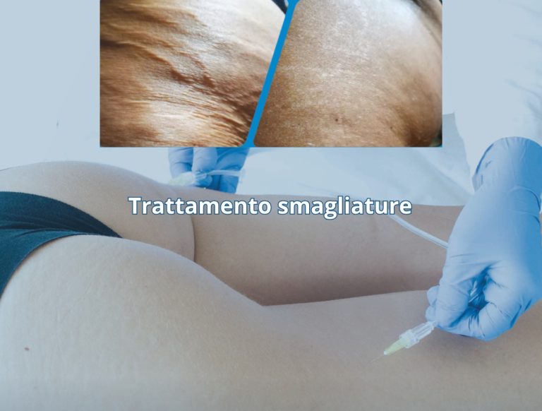 trattamento smagliature