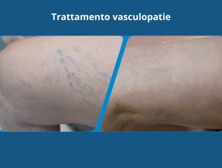 trattamento vasculopatie